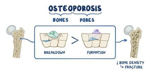 Diagram breaking the term into "osteo", meaning bones, "porosis" meaning pores, and showing the loss of bone density