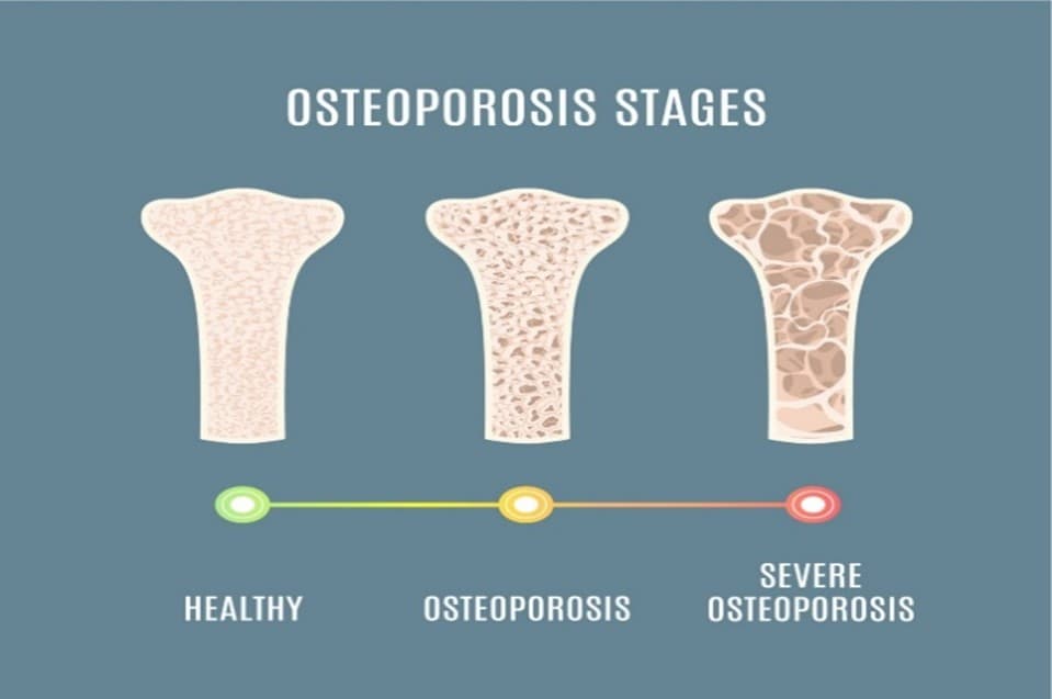 Diagram showing the stages of osteoporosis, with maximum bone density at healthy levels, to minimal at extreme osteoporosis levels